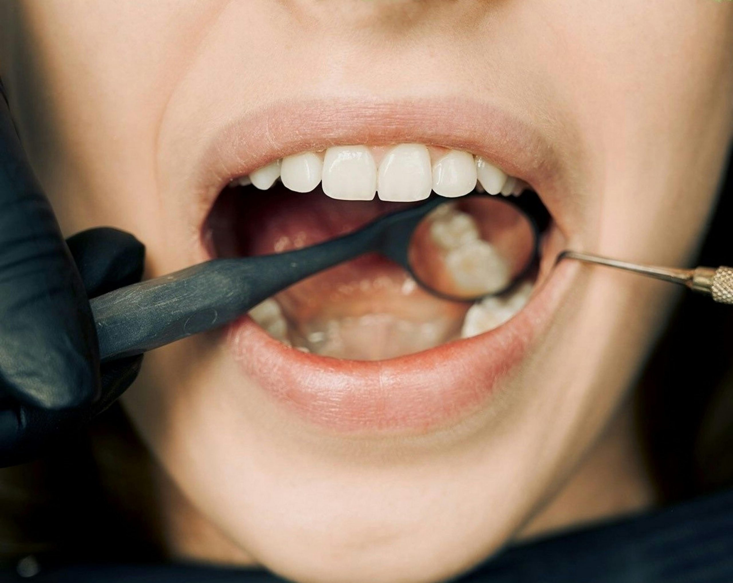 mouth open wide with a dentist's mirror reflecting two teeth